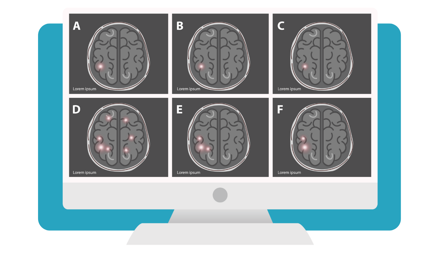 diagnosing Alzheimer's disease